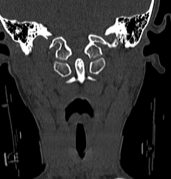 File:Normal CT cervical spine - 12-year-old (Radiopaedia 55352-61775 Coronal bone window 45).jpg