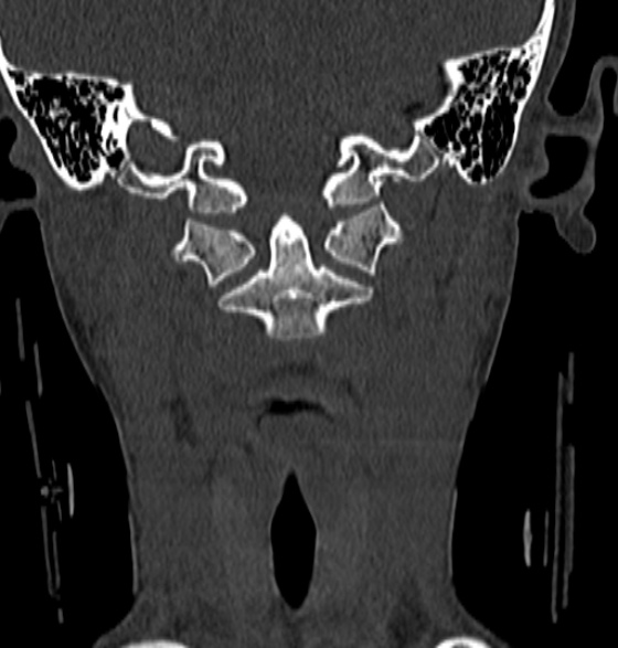 File:Normal CT cervical spine - 12-year-old (Radiopaedia 55352-61775 Coronal bone window 58).jpg