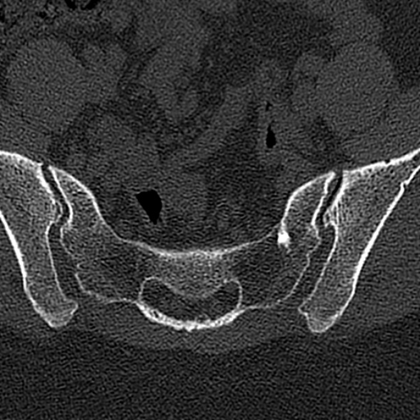 File:Normal CT lumbar spine (Radiopaedia 53981-60118 Axial bone window 76).jpg