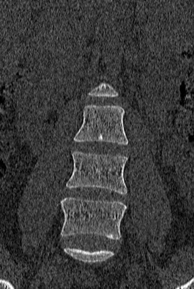 Normal CT lumbar spine (Radiopaedia 53981-60118 Coronal bone window 15).jpg
