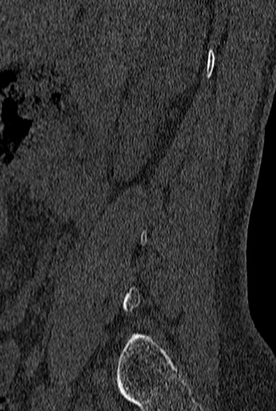 File:Normal CT lumbar spine (Radiopaedia 53981-60118 Sagittal bone window 4).jpg