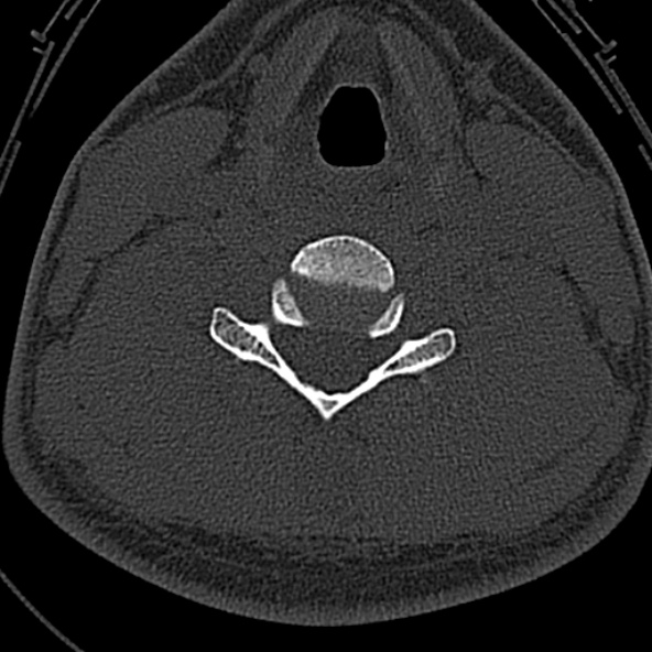 Normal CT of the cervical spine (Radiopaedia 53322-59305 Axial bone window 170).jpg