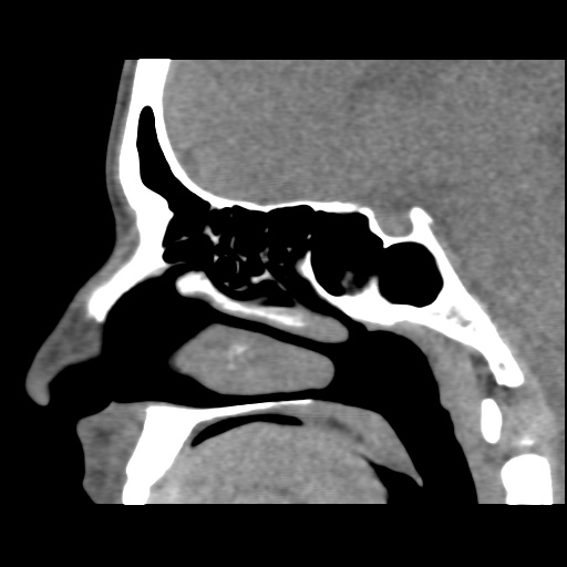 Normal CT paranasal sinuses (Radiopaedia 42286-45390 F 71).jpg