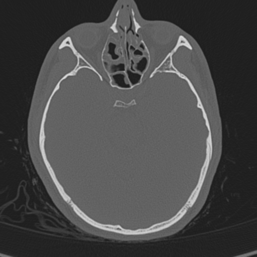 Normal CT skull (Radiopaedia 40798-43459 A 58).png