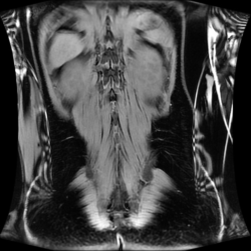 Normal MRI abdomen in pregnancy (Radiopaedia 88001-104541 M 116).jpg