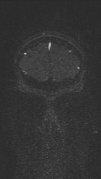Normal MRI brain with MRV- teenager (Radiopaedia 49425-54553 Coronal MRV 45).jpg