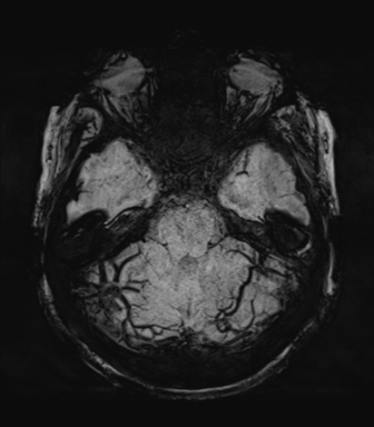 Normal MRI internal auditory canal (Radiopaedia 41613-44525 Axial SWI MIP 23).png