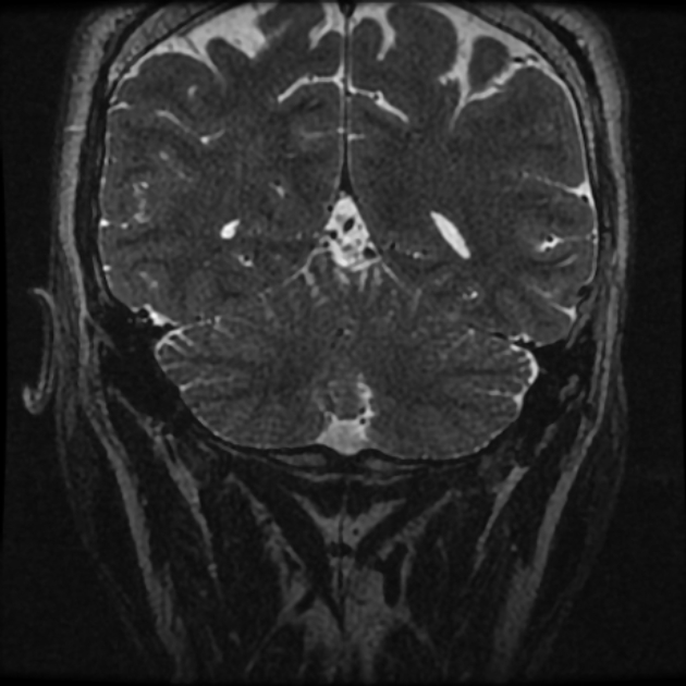 Normal MRI petrous (Radiopaedia 91317-108949 Coronal T2 115).jpg