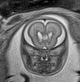Normal brain fetal MRI - 22 weeks (Radiopaedia 50623-56050 Coronal T2 Haste 18).jpg