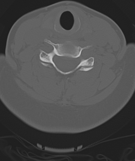 Normal cervical spine MRI (including Dixon) (Radiopaedia 42762-45926 Axial bone window 37).png