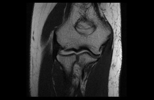 File:Normal elbow arthrograms (Radiopaedia 75550-86805 Coronal T1 8).jpg