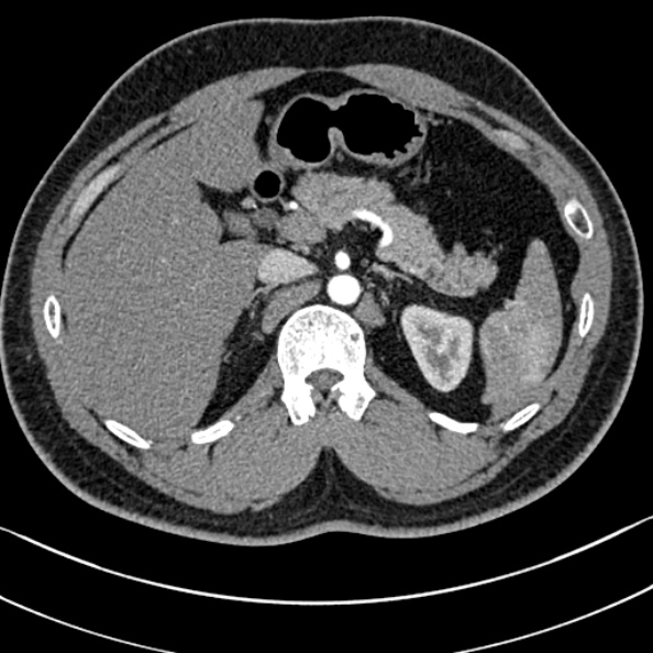Normal kidneys on 4-phase CT study (Radiopaedia 25889-26038 B 11).jpg