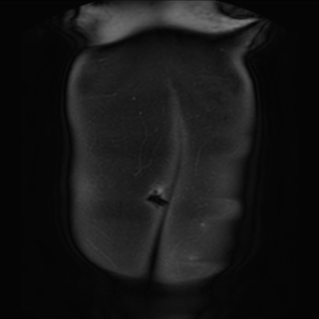 Normal liver MRI with Gadolinium (Radiopaedia 58913-66163 P 3).jpg
