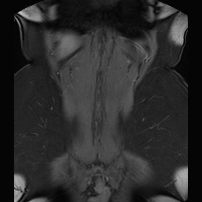 Normal liver MRI with Gadolinium (Radiopaedia 58913-66163 P 77).jpg
