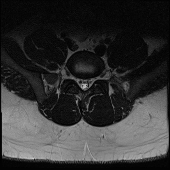 File:Normal lumbar spine MRI (Radiopaedia 47857-52609 Axial T2 26).jpg