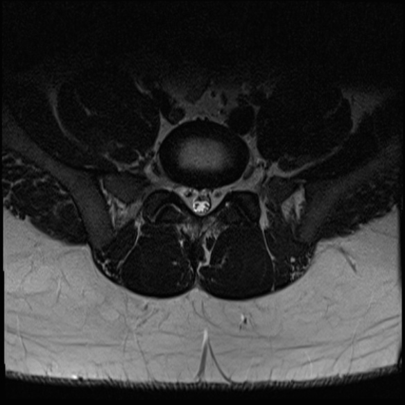 File:Normal lumbar spine MRI (Radiopaedia 47857-52609 Axial T2 27).jpg