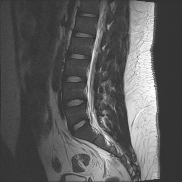 File:Normal lumbar spine MRI (Radiopaedia 47857-52609 Sagittal T2 12).jpg