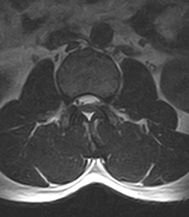 Normal lumbar spine MRI - low-field MRI scanner (Radiopaedia 40976-43699 Axial T2 36).jpg