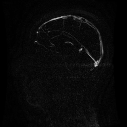Normal noncontrast MR venography (Radiopaedia 87578-103957 A 87).jpg