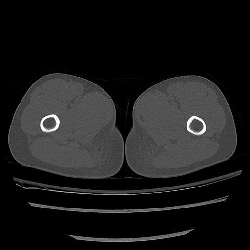 Normal pelvis CT (Radiopaedia 51471-57236 Axial bone window 111).jpg