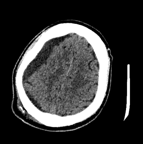 Normal pressure hydrocephalus (Radiopaedia 73685-84479 Axial non-contrast 63).jpg