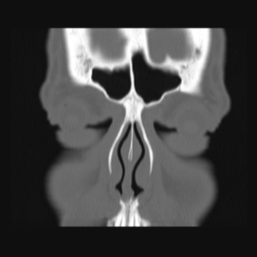 Normal sinus CT (annotated) (Radiopaedia 78917-91810 Coronal bone window 16).jpg