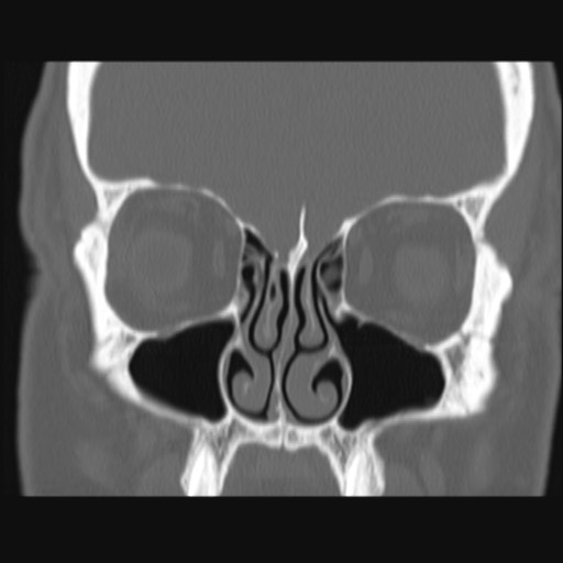 Normal sinus CT (annotated) (Radiopaedia 78917-91810 Coronal bone window 25).jpg