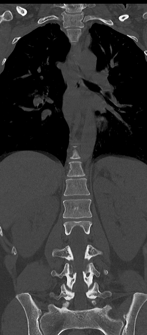 Normal thoracolumbar spine (Radiopaedia 43822-47309 Coronal bone window 47).png