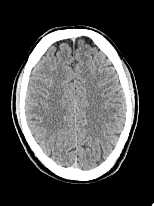 Normal trauma protocol brain and C-spine CT (Radiopaedia 83302-97709 Axial non-contrast 27).jpg