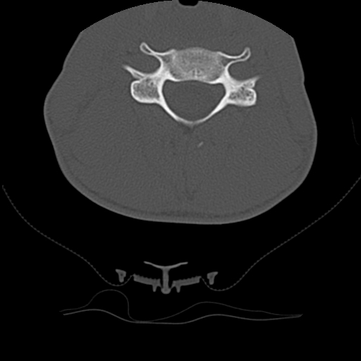 File:Normal trauma spine imaging (age 16) (Radiopaedia 45335-49358 Axial bone window 44).jpg