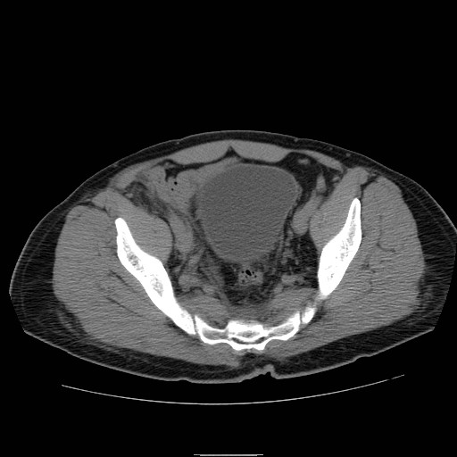 File:Obstructed kidney with perinephric urinoma (Radiopaedia 26889-27066 Axial non-contrast 56).jpg