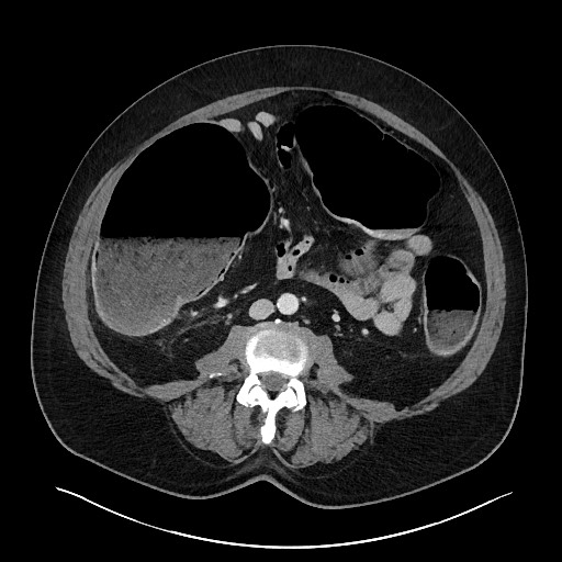 Obstructing sigmoid adenocarcinoma (Radiopaedia 58465-65619 A 94).jpg