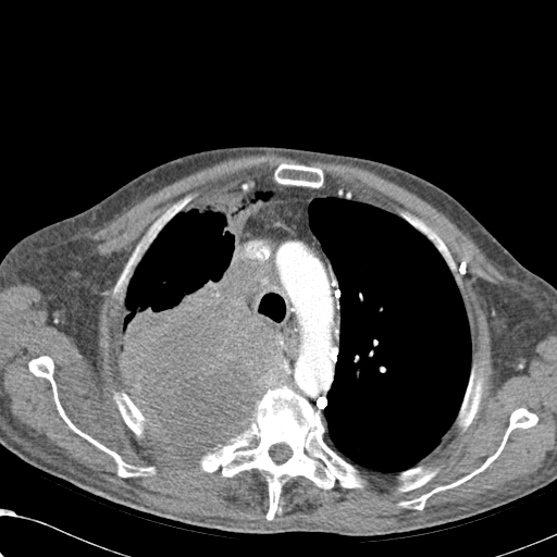 File:Obstructive superior vena cava tumor thrombus (Radiopaedia 28046-28306 A 16).jpg