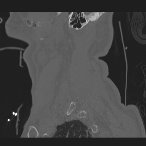 File:Occipital condyle fracture (Radiopaedia 33467-34517 Sagittal bone window 69).png