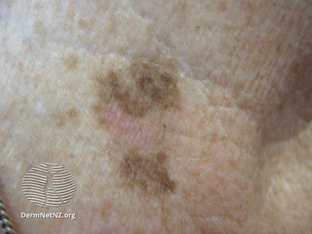 File:See more images of lentigines... (DermNet NZ lesions-lentigo4).jpg