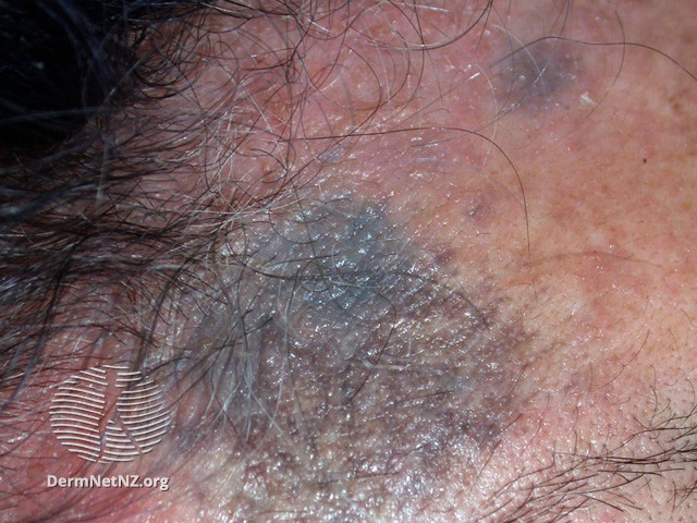 File:(DermNet NZ dermatitis-acd-face-2431).jpg