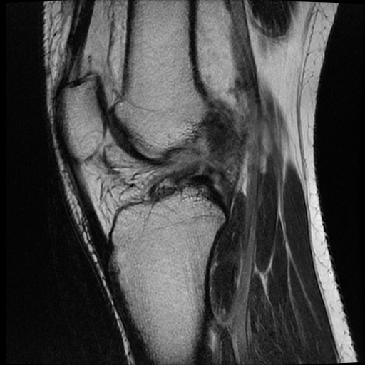 File:ACL acute full thickness tear - deep lateral femoral sulcus sign (Radiopaedia 38594-40740 Sagittal T2 12).jpg