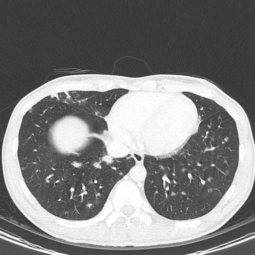 AIDS-related Kaposi sarcoma (Radiopaedia 85247-100811 Axial lung window 131).jpg