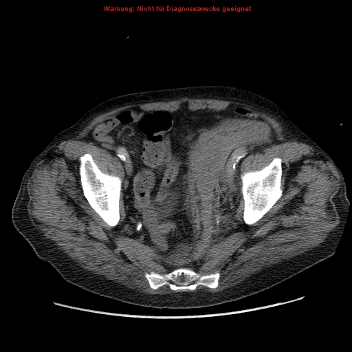 Abdominal aortic aneurysm- extremely large, ruptured (Radiopaedia 19882-19921 Axial C+ arterial phase 67).jpg