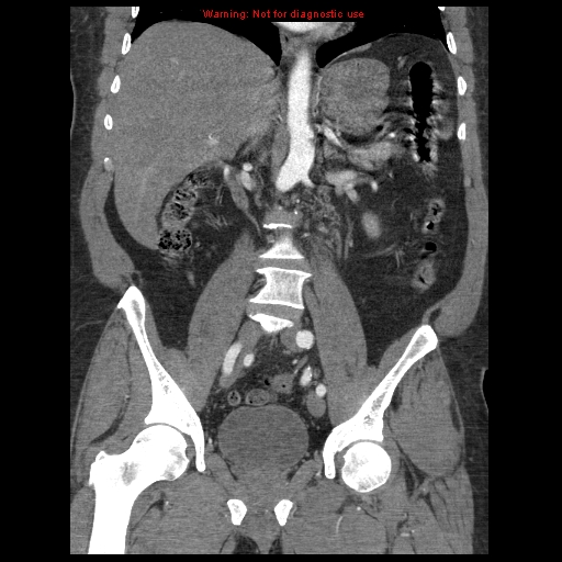 Abdominal aortic aneurysm (Radiopaedia 8190-9038 Coronal C+ arterial phase 71).jpg