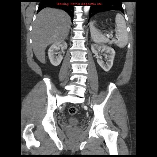 File:Abdominal aortic aneurysm (Radiopaedia 8190-9038 Coronal C+ arterial phase 85).jpg
