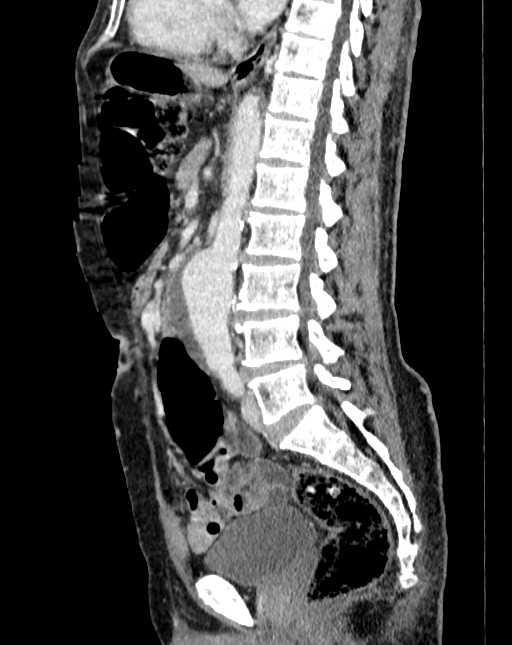 Abdominal aortic aneurysm (Radiopaedia 83581-98689 Sagittal C+ portal venous phase 54).jpg