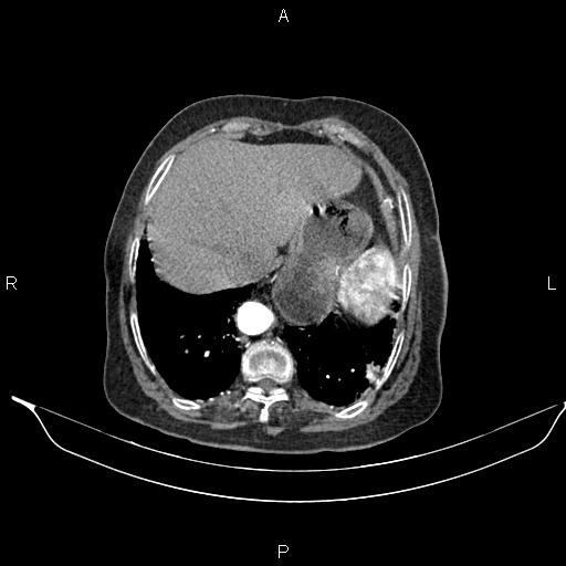 File:Abdominal aortic aneurysm (Radiopaedia 85063-100606 Axial C+ arterial phase 27).jpg