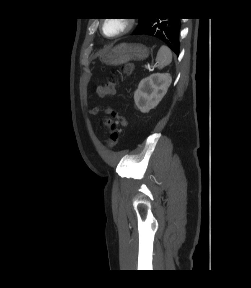 Abdominal aortic aneurysm with thrombus fissuration (Radiopaedia 46218-50618 Sagittal C+ arterial phase 49).jpg