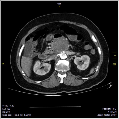 Abdominal aortic aneurysm with thrombus fissuration (Radiopaedia 47340-51926 Axial C+ arterial phase 20).jpg