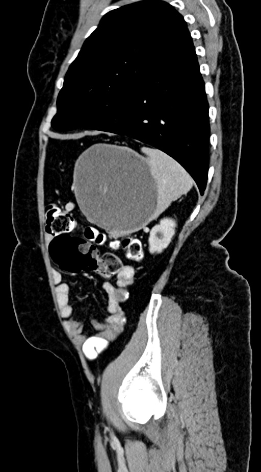 Abdominal hydatid disease (Radiopaedia 68223-77737 Sagittal C+ portal venous phase 16).jpg