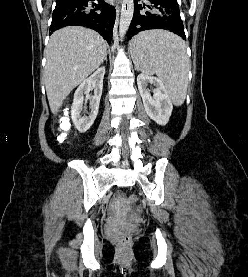 Abdominal lymphoma with sandwich sign (Radiopaedia 84378-99704 Coronal C+ portal venous phase 47).jpg