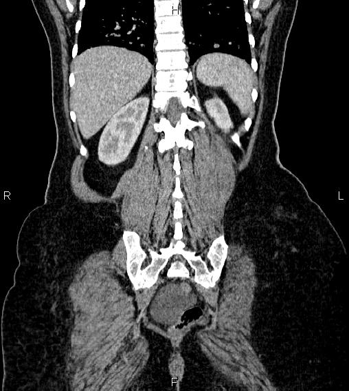 Abdominal lymphoma with sandwich sign (Radiopaedia 84378-99704 Coronal C+ portal venous phase 56).jpg
