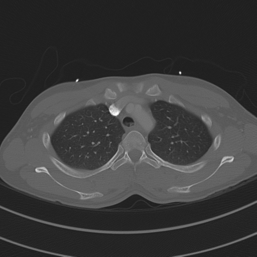 File:Abdominal multi-trauma - devascularised kidney and liver, spleen and pancreatic lacerations (Radiopaedia 34984-36486 I 23).png