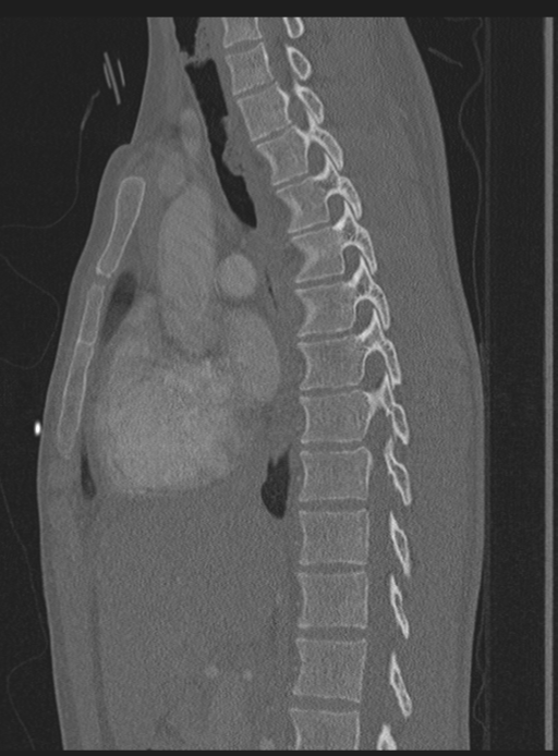 Abdominal multi-trauma - devascularised kidney and liver, spleen and pancreatic lacerations (Radiopaedia 34984-36486 Sagittal bone window 39).png